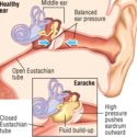 Ear Infections: What you need to know..